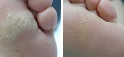 Bradavice predstavljaju jednu od češćih kožnih infekcija koje se mogu ukloniti laserima/Foto: Poliklinika Maletić