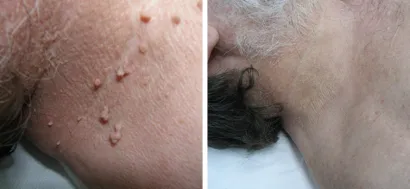Fibromi se efektno uklanjaju erbijskim laserom/Foto: Poliklinika Maletić