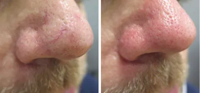 Proširene kapilare na licu i nogama predstavljaju čest problem, a lasersko uklanjanje daje najbolje rezultate/Foto: Poliklinika Maletić