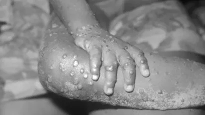 Foto: CDC's Public Health Image Library/Wikipedia