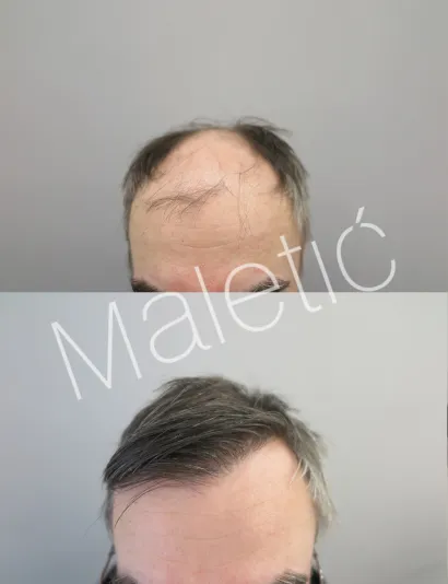 Promjene nakon transplantacije više su nego vidljive/Foto: Ana Maletić