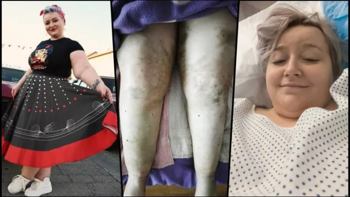 Kristina Dalponte se od svoje 13. godine muči s ovim problemom/Foto: Privatni album