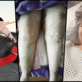 Kristina Dalponte se od svoje 13. godine muči s ovim problemom/Foto: Privatni album