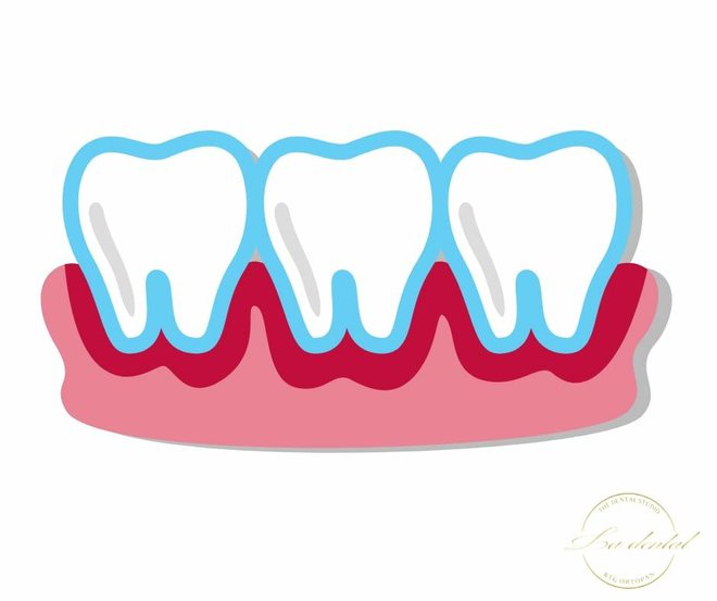 <p>Natečeno i crveno zubno meso simptom je parodontoze i znak da je vrijeme za posjet stomatologu/Foto: La dental</p>
