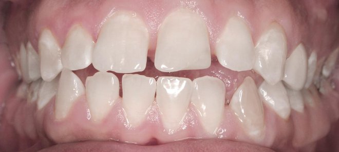 Loše poredani zubi/ Foto: ClearCorrect
