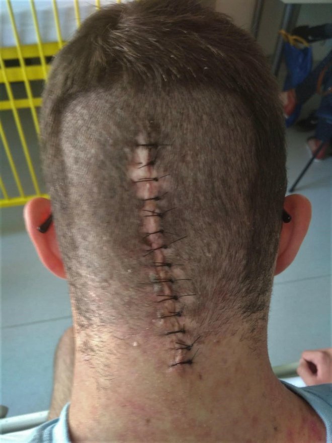 Rezna rana nakon operacije Alojzu stvara najviše problema/Foto: Privatni album
