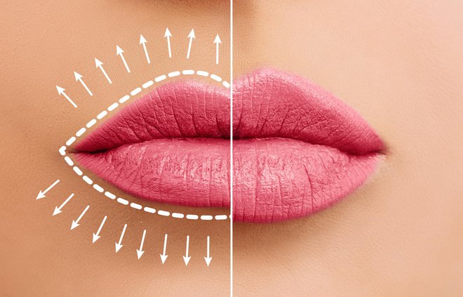 Inovativni fileri Belotero Lips Shape & Contour osmišljeni su kako bi se izbjegao tzv. 'duckface' izgled, a imaju isti efekt poput olovke i ruža za usne u svijetu kozmetike/Getty Images/iStockphoto
