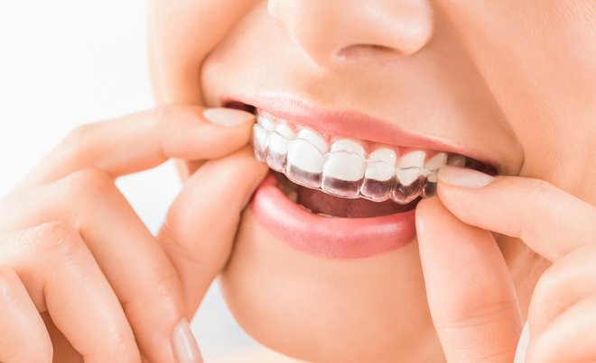 Prozirni aparatić za zube veliki he svjetski hit jer je gotovo neprimjetan i sami ga možete skinuti i ponovno staviti/Foto: Getty Images/iStockphoto
