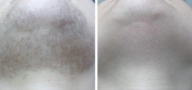 Laserskim tretmanom možte trajno ukloniti neželjene dlačice/Foto: Poliklinika Maletić
